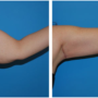 A closeup woman's left arm before and after brachioplasty