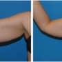 closeup woman's right arm before and after brachioplasty
