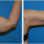 A woman's left arm before and after brachioplasty