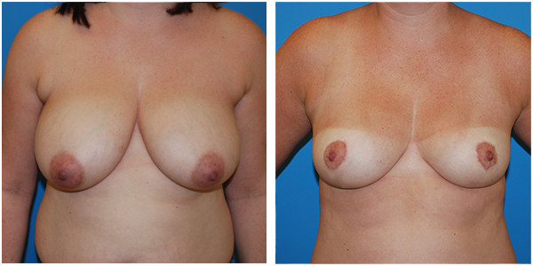 Breast reduction medium front side view before and after