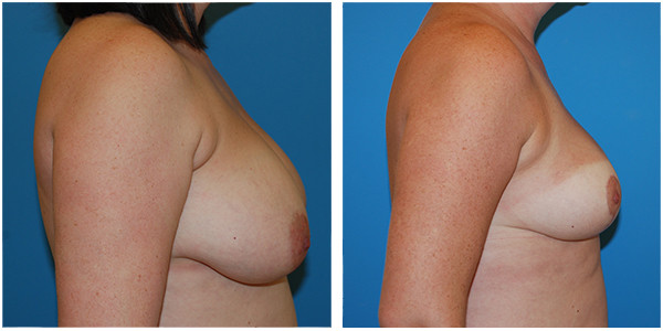 a woman breast right side view showcasing breast reduction before and after surgery