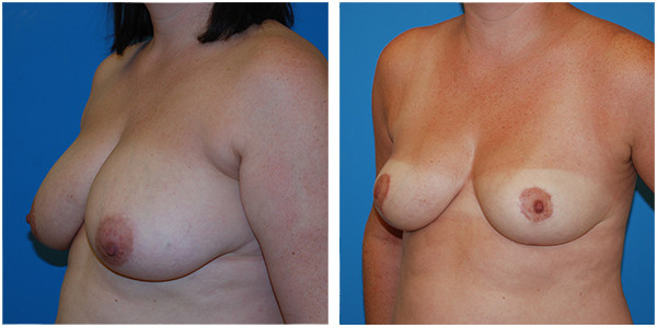 a woman breast front left angle side view showcasing breast reduction before and after surgery by Dr Jennifer Capla