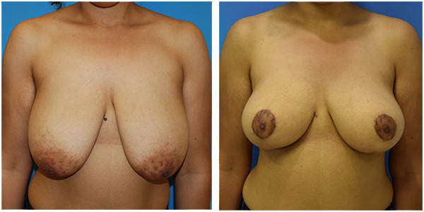 a woman breast front side view showcasing breast reduction results before and after surgery by Dr Jennifer Capla