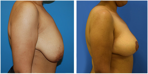 a woman breast Right side view showcasing breast reduction results before and after surgery by Dr Jennifer Capla