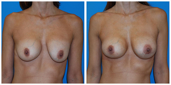 A woman's breast before and after breast lift, featuring J.C