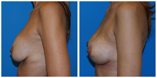 A woman's breast before and after breast surgery and lift right side, featuring J.C