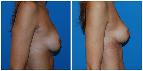 A woman's breast before and after surgery right side, featuring J.C