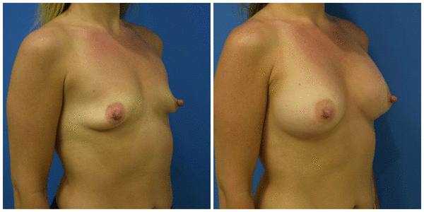a woman standing breast front side view showcasing breast augmentation before and after surgery C12