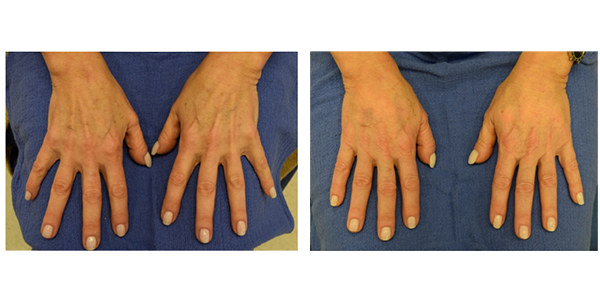 A woman's hands are shown before and after surgery, by Dr. J.C