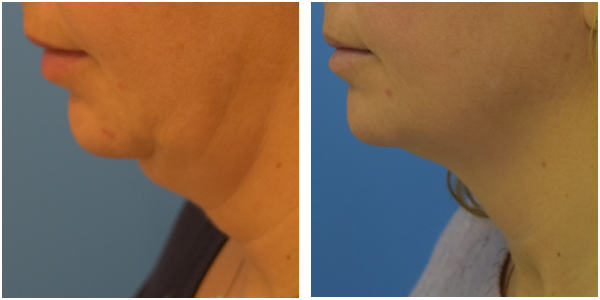 A before and after picture of a woman's neck, Kybela surgery by Dr . J.C