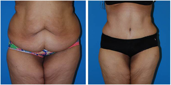 woman standing front side view showcasing Murillo abdominoplasty before and after surgery by Dr Jennifer Capla