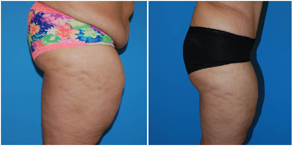 woman standing right side view showcasing morillo abdominoplasty before and after