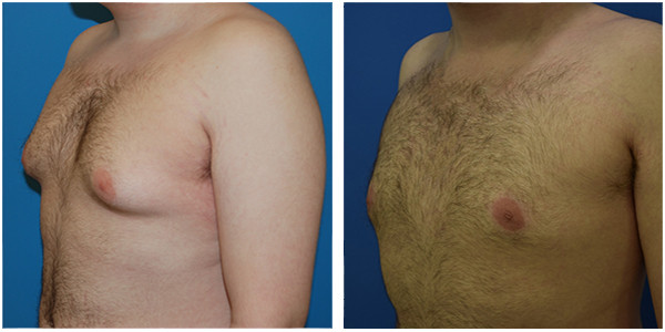 a man front left angle side view showcasing gynecomastia before and after surgery