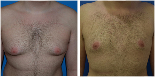 a man standing showcasing gynecomastia before and after surgery front view