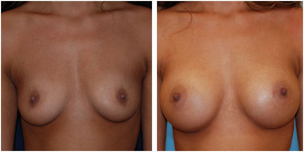 a woman breast front side view showcasing breast augmentation before and after surgery by Dr Jennifer Capla