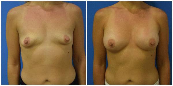 a woman breast front side right angle view of breast augmentation surgery before and after A14