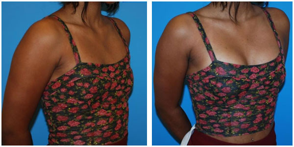 A woman standing right side view showcasing results of Breast Saline Injection before and after