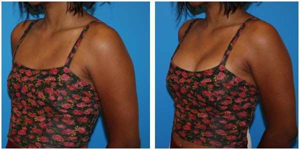 A woman standing face view showcasing results of Breast Saline Injection before and after