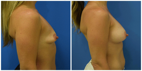 a woman standing breast right side view showcasing breast augmentation before and after surgery B1
