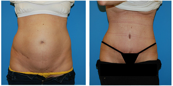 woman standing front view showcasing abdominoplasty before and after surgery by Dr Jennifer Capla