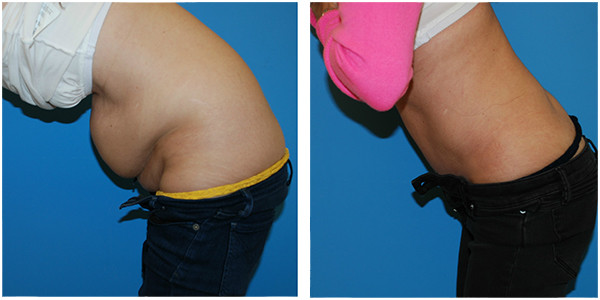 woman standing and bending forward left side view showcasing abdominoplasty before and after
