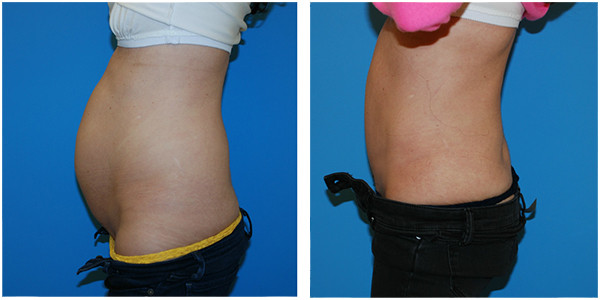 woman standing lateral left side view showcasing abdominoplasty before and after