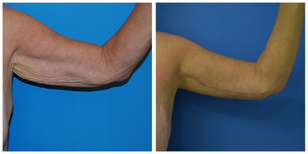 brachio fullscar before and after surgery left arm