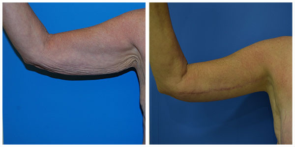 arm before and after surgery right arm