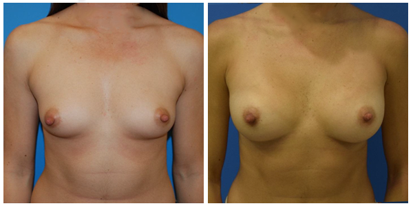 a woman standing breast front side view showcasing breast augmentation before and after surgery C
