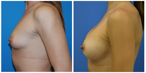 a woman breast left side view showcasing breast augmentation before and after surgery C2
