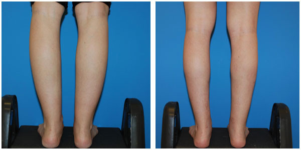 a girl leg's back view showcasing before and after ankle Surgery by Dr Jennifer Capla