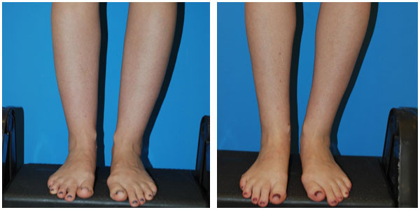 a woman leg's font view showcasing before and after ankle Surgery by Dr Jennifer Capla