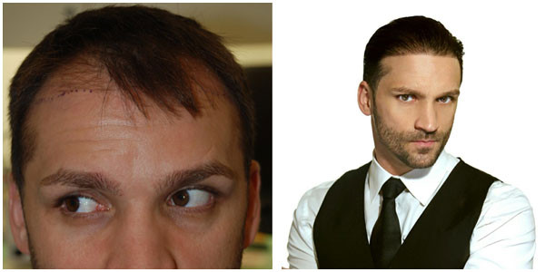 A man head and face showcasing before and after hair restoration