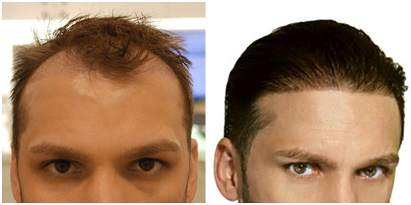 A man head and face showcasing before and after black hair restoration