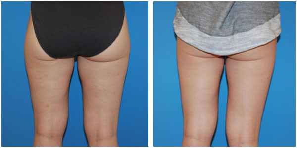 Woman Thigh Back view before and after Surgery