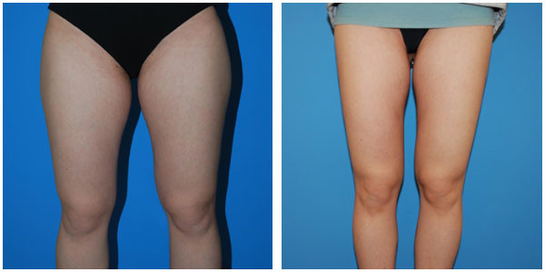 Woman Thigh front view before and after Surgery