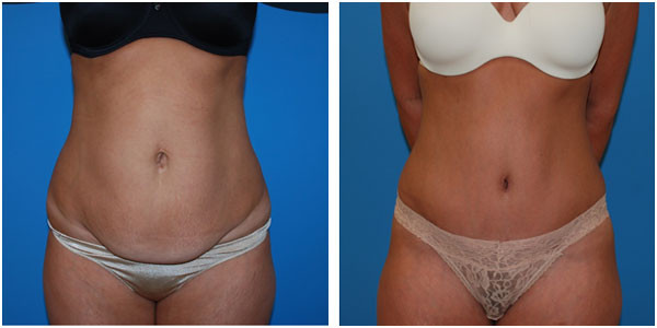 woman standing front view showcasing abdominoplasty before and after by Dr Jennifer Capla
