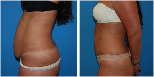 woman standing left view showcasing abdominoplasty before and after by Dr Capla
