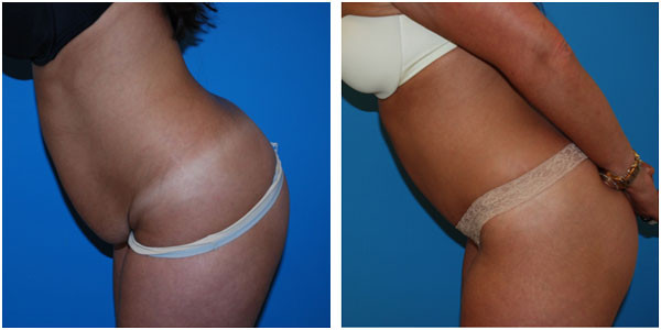 woman standing left side view showcasing abdominoplasty before and after