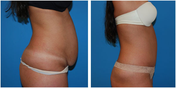 woman standing right side view showcasing abdominoplasty before and after