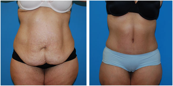 woman standing front view showcasing abdominoplasty before and after