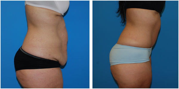 woman standing and right side view showcasing abdominoplasty before and after surgery