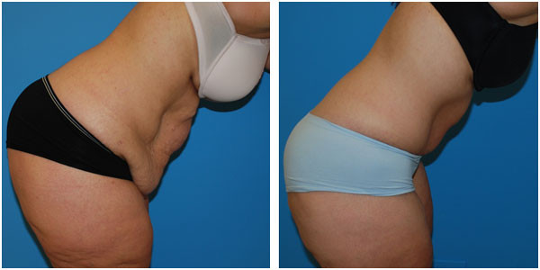 woman standing and bending forward right side view showcasing abdominoplasty before and after surgery