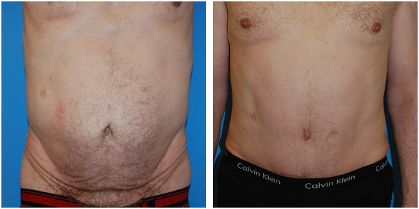 abdominoplasty male front before and after By Dr. a J.C