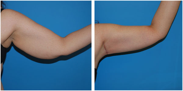 A closeup woman's left arm before and after brachioplasty