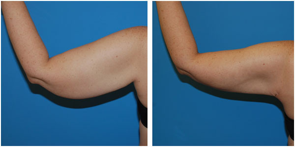 A woman's right arm before and after brachioplasty by Dr Jennifer Capla