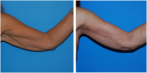 A woman's Left arm before and after brachioplasty by Dr Jennifer Capla