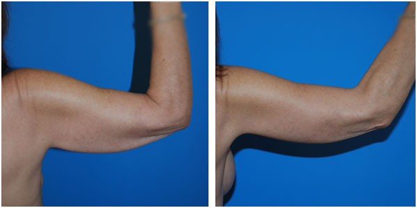 A woman's right arm back view before and after brachioplasty by Dr Jennifer Capla