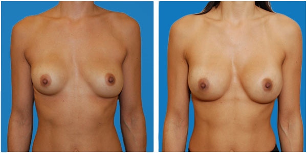 a woman Standing front side view showcasing breast augmentation before and after surgery C3