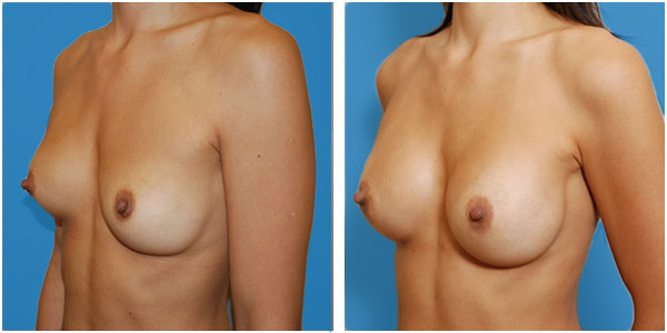 a woman breast front side view showcasing breast augmentation surgery results before and after results by Dr Jennifer Capla